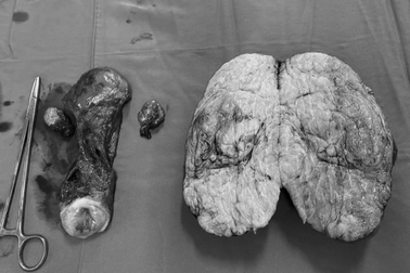 Khối u khủng trong bụng người phụ nữ vì chủ quan không điều trị