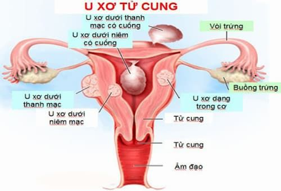 Ago Tumor giải pháp mới, hỗ trợ giảm triệu chứng u xơ tử cung, u vú lành tính - 2 Ago Tumor giải pháp mới, hỗ trợ giảm triệu chứng u xơ tử cung, u vú lành tính - 2