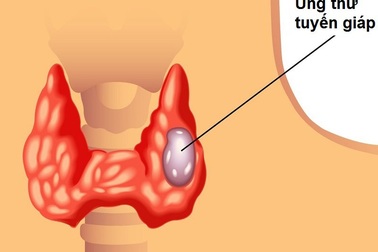 Sinh thiết bằng kim có chính xác?