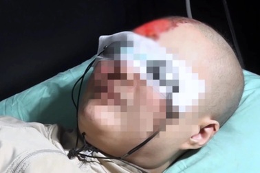 Nhiều bệnh nhân zona thần kinh gặp "thảm cảnh" vì chữa bằng bùa khoán