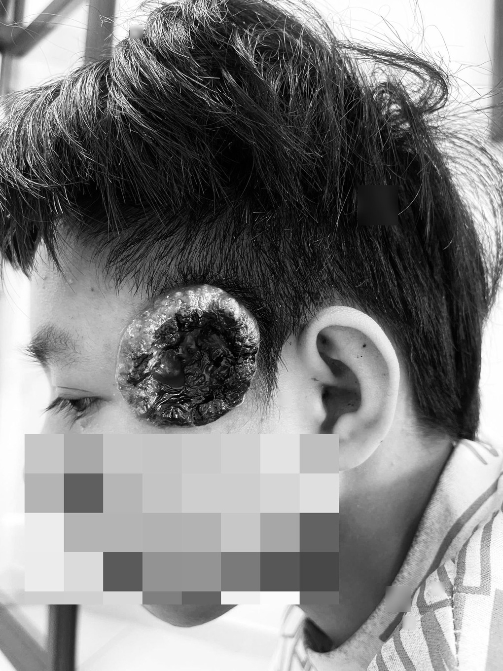 Khối u thái dương vỡ loét, thiếu niên 16 tuổi phát hiện ung thư da - 1
