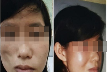 Cô gái bỗng dưng bị lép một nửa mặt