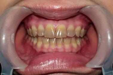 Giải pháp cho răng nhiễm Tetracycline