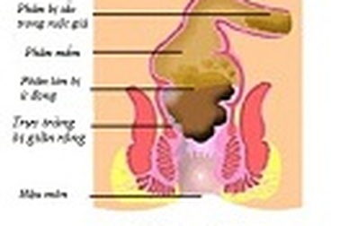 Trị táo bón và tránh tái phát hiệu quả bằng cách nào?