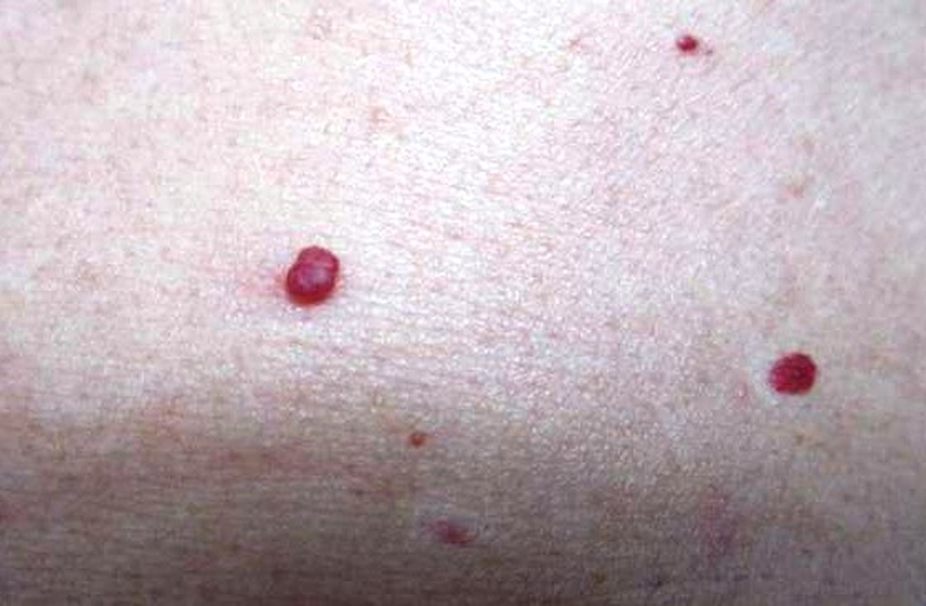 Có chấm đỏ này trên da có thể gan đã hỏng nặng - 2 Có chấm đỏ này trên da có thể gan đã hỏng nặng - 2