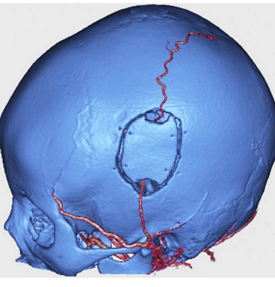Bé 5 tuổi nhiều lần đột quỵ vì làn khói trong não - 2 Bé 5 tuổi nhiều lần đột quỵ vì làn khói trong não - 2
