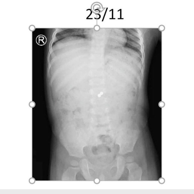2 viên bi nam châm nằm trong bụng 6 tháng, bé trai nguy cơ hoại tử ruột nếu không phát hiện kịp thời - Ảnh 2.