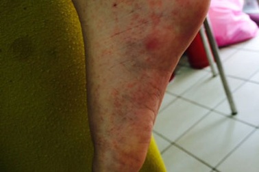 Sẽ tiêm vắc xin sởi bổ sung với đối tượng chưa tiêm chủng