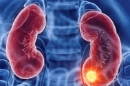 Các triệu chứng thường gặp của ung thư thận