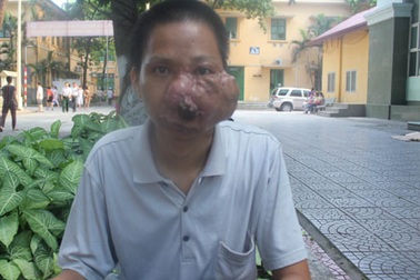 Gần 15 năm “đeo” khối u to như quả bưởi trên mặt