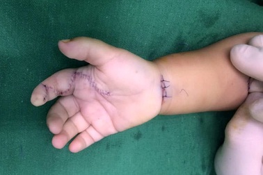 Cầm phải sâu róm, bé 1 tuổi bị viêm thành ổ mủ vì sai lầm của cha mẹ