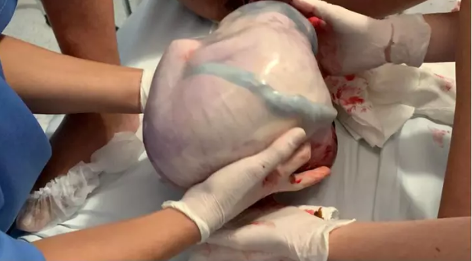 Cực hiếm: Một bé trong cặp sinh đôi còn nguyên trong túi ối - 1 Cực hiếm: Một bé trong cặp sinh đôi còn nguyên trong túi ối - 1
