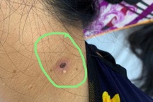 Người phụ nữ bị suy gan, hôn mê chỉ vì một vết đốt ở cổ