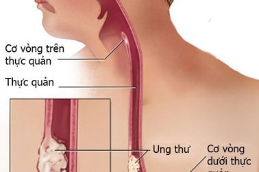 Các giai đoạn của ung thư thanh quản