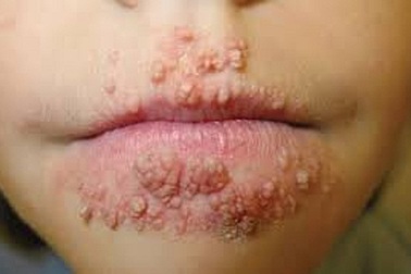 Sùi mào gà có thể lây cho trẻ như thế nào?