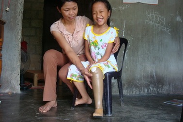 Ước mơ có chiếc chân giả của bé Văn Nhật Thảo đã thành hiện thực