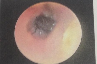 Nhập viện cấp cứu vì bị ruồi chui vào tai