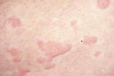 Phản ứng phụ thường gặp của thuốc kháng sinh 