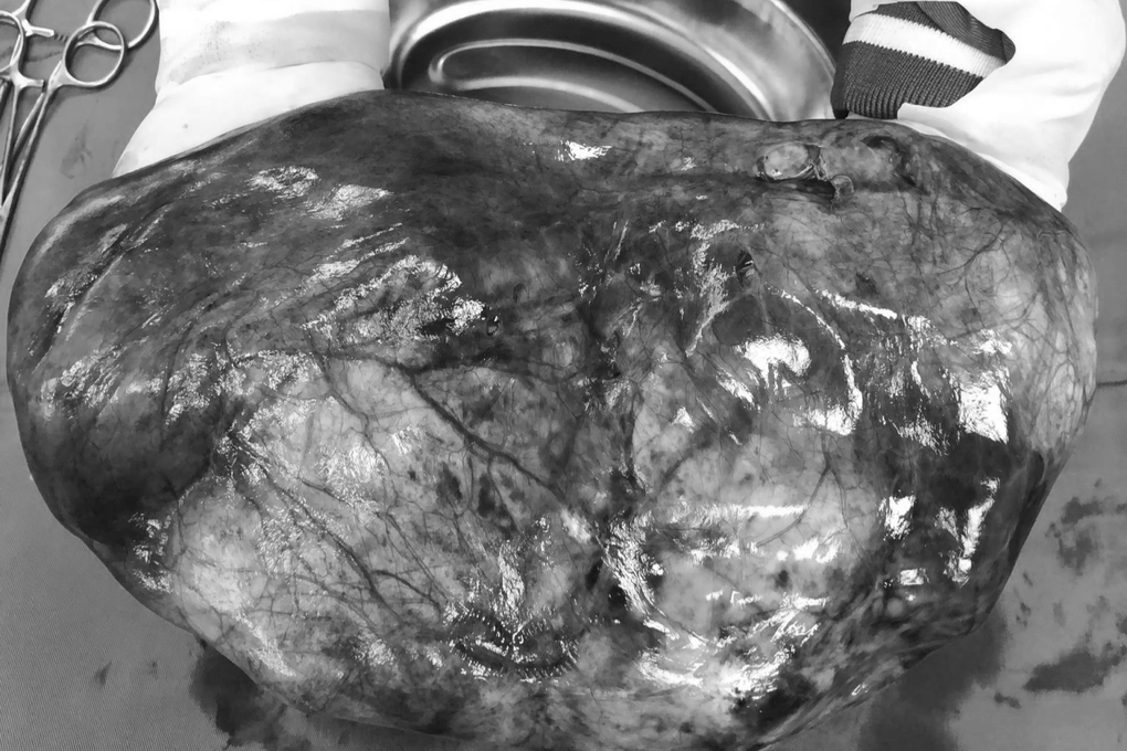 Lấy thành công khối u to như quả bóng cho sản phụ mang thai 14 tuần - 1