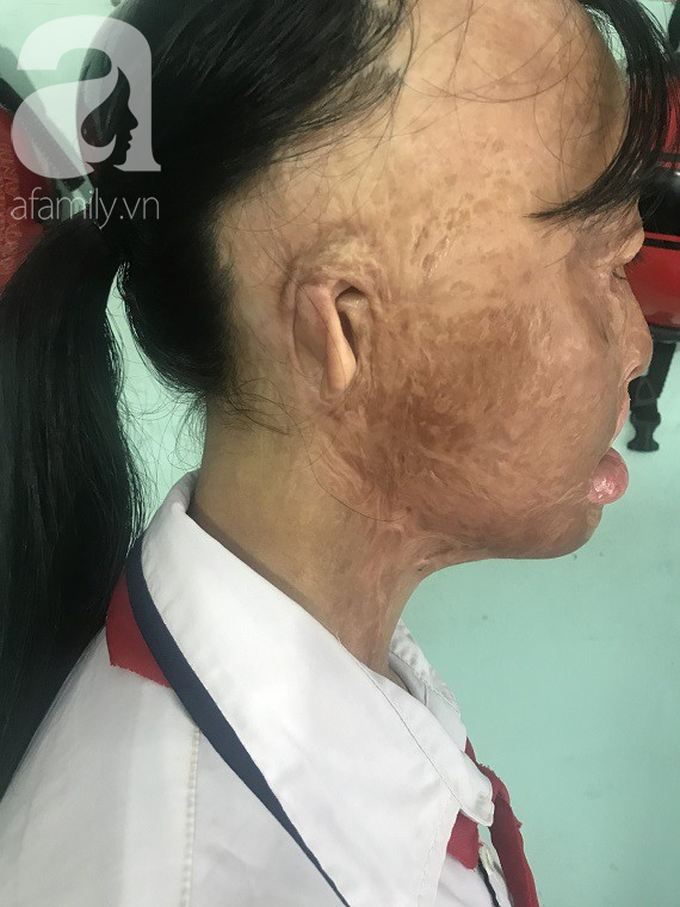 Bé gái biến dạng khuôn mặt, mất một bên tai và ước mơ nhói lòng: Em muốn làm họa sĩ để vẽ mình đẹp hơn - Ảnh 5. Bé gái biến dạng khuôn mặt, mất một bên tai và ước mơ nhói lòng: Em muốn làm họa sĩ để vẽ mình đẹp hơn - Ảnh 5.