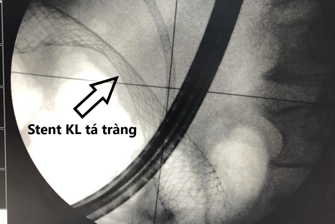 Căn bệnh khiến người phụ nữ lâm nguy vì cứ ăn là nôn, không thể đại tiện - 1 Căn bệnh khiến người phụ nữ lâm nguy vì cứ ăn là nôn, không thể đại tiện - 1