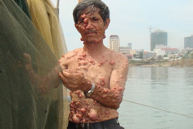 Những khối u phiền toái của ông Sáu “dị nhân”