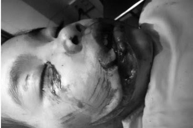 Dùng tới 7,5m chỉ để khâu gương mặt bệnh nhi bị chó cắn nát