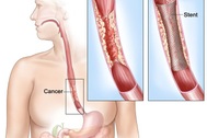 Dấu hiệu ung thư thực quản khi đã tiến triển