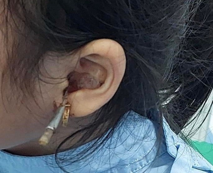 Bé gái bị dị vật xuyên ống tai gây tổn thương tai giữa vừa được Bệnh viện Nhi đồng TP. Cần Thơ tiếp nhận và cứu chữa.