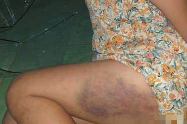 Đắk Lắk: Tạm đình chỉ cô giáo đánh bầm tím đùi học sinh lớp 3