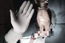 Đại phẫu cứu bé gái “tí hon” vừa chào đời bị tắc ruột