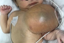 Bé trai chào đời mang theo khối u khổng lồ trên ngực