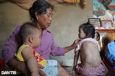 Xót xa cảnh bé gái 4 tuổi oằn mình chịu đựng nhiều khối u lớn trên lưng