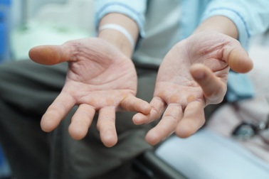 “Đốt tiền" vào bóng cười, vợ chồng 9X liệt chân, giảm trí nhớ