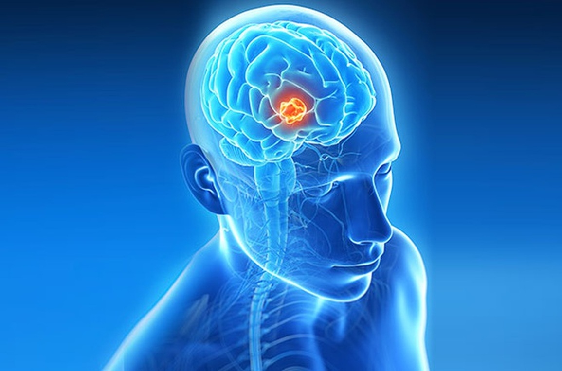 Đau đầu, tê bì mặt: Dấu hiệu cảnh báo bệnh não nguy hiểm - 1 Đau đầu, tê bì mặt: Dấu hiệu cảnh báo bệnh não nguy hiểm - 1