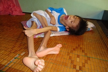 Xót xa bé gái 5 tuổi chờ chết vì chứng bệnh lạ