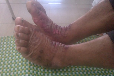 Vụ bệnh nhân dày sừng tử vong: Bị nhiễm trùng huyết, suy đa phủ tạng