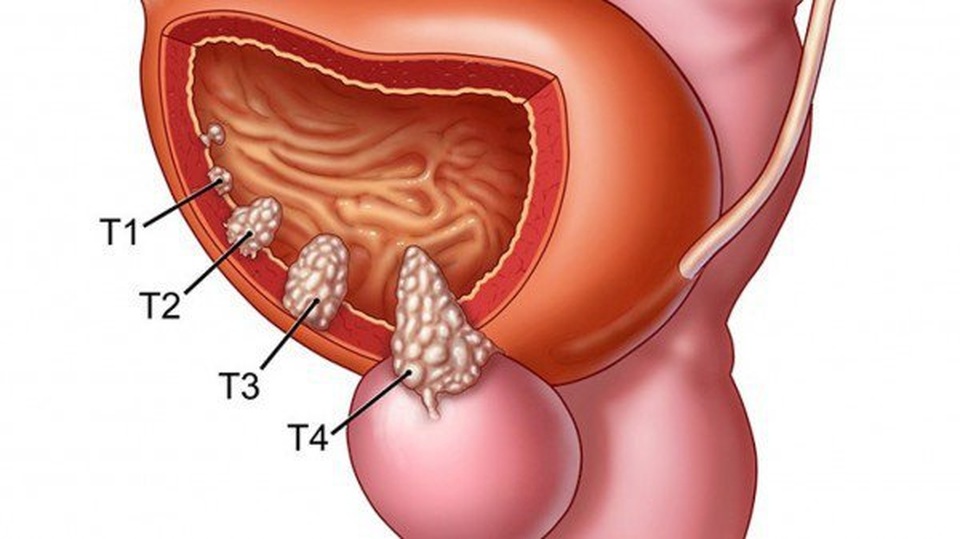 Điều trị ung thư bàng quang theo từng giai đoạn - 1 Điều trị ung thư bàng quang theo từng giai đoạn - 1
