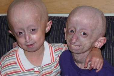 Top 10 căn bệnh kỳ lạ và đáng sợ nhất trên thế giới, y học chưa có lời giải