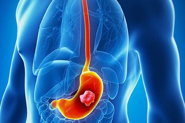 Ung thư dạ dày: đừng để bị “đánh lừa” bởi các triệu chứng viêm dạ dày thông thường