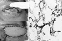 Bệnh nấm đen nguy hiểm mới nổi: Tấn công gây hoại tử não, tim...