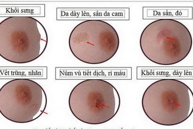 Cách tự kiểm tra phát hiện ung thư vú