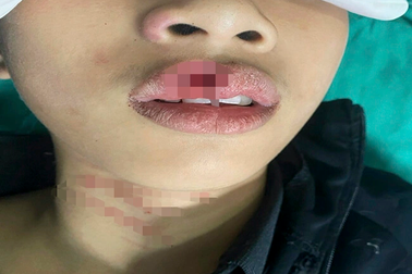 Có nên súc bằng nước muối, nước ấm khi trẻ chảy máu miệng?