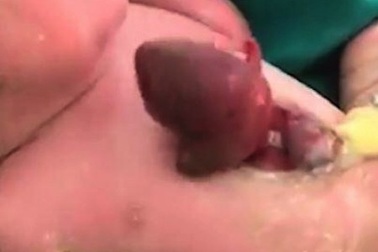 Thương bé sơ sinh có trái tim đập ngoài lồng ngực