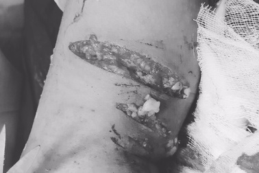 Bé trai 7 tuổi phải khâu 70 mũi sau khi bị chó ngoạm lòi cơ chân