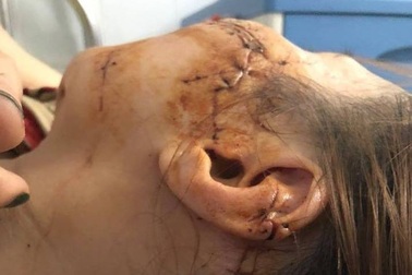 Kinh hoàng người phụ nữ bị chồng dùng dao rạch nhiều nhát lên mặt