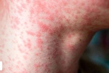Nhiều người lớn nhập viện vì mắc sởi