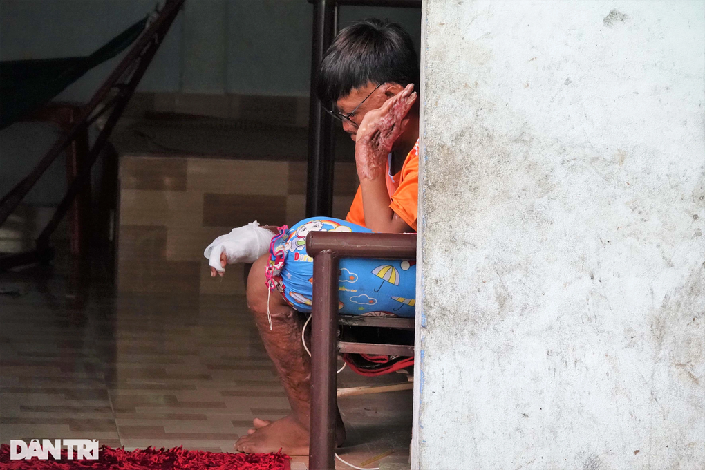 Thương cậu bé liều mình cứu mẹ nuôi lúc nổ bình gas khiến cơ thể biến dạng - 2 Thương cậu bé liều mình cứu mẹ nuôi lúc nổ bình gas khiến cơ thể biến dạng - 2