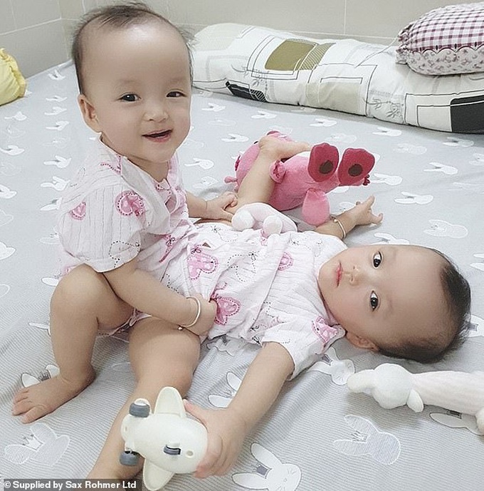 Ca phẫu thuật tách rời thành công cặp song sinh Trúc Nhi - Diệu Nhi của các y bác sĩ Việt Nam thu hút sự chú ý báo chí nước ngoài - Ảnh 1. Ca phẫu thuật tách rời thành công cặp song sinh Trúc Nhi - Diệu Nhi của các y bác sĩ Việt Nam thu hút sự chú ý báo chí nước ngoài - Ảnh 1.