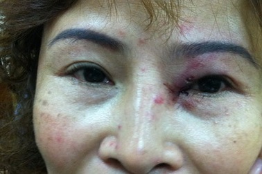 Bi kịch về người phụ nữ bị chồng “hờ” hành hung dã man